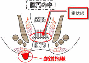 血栓性外痔核